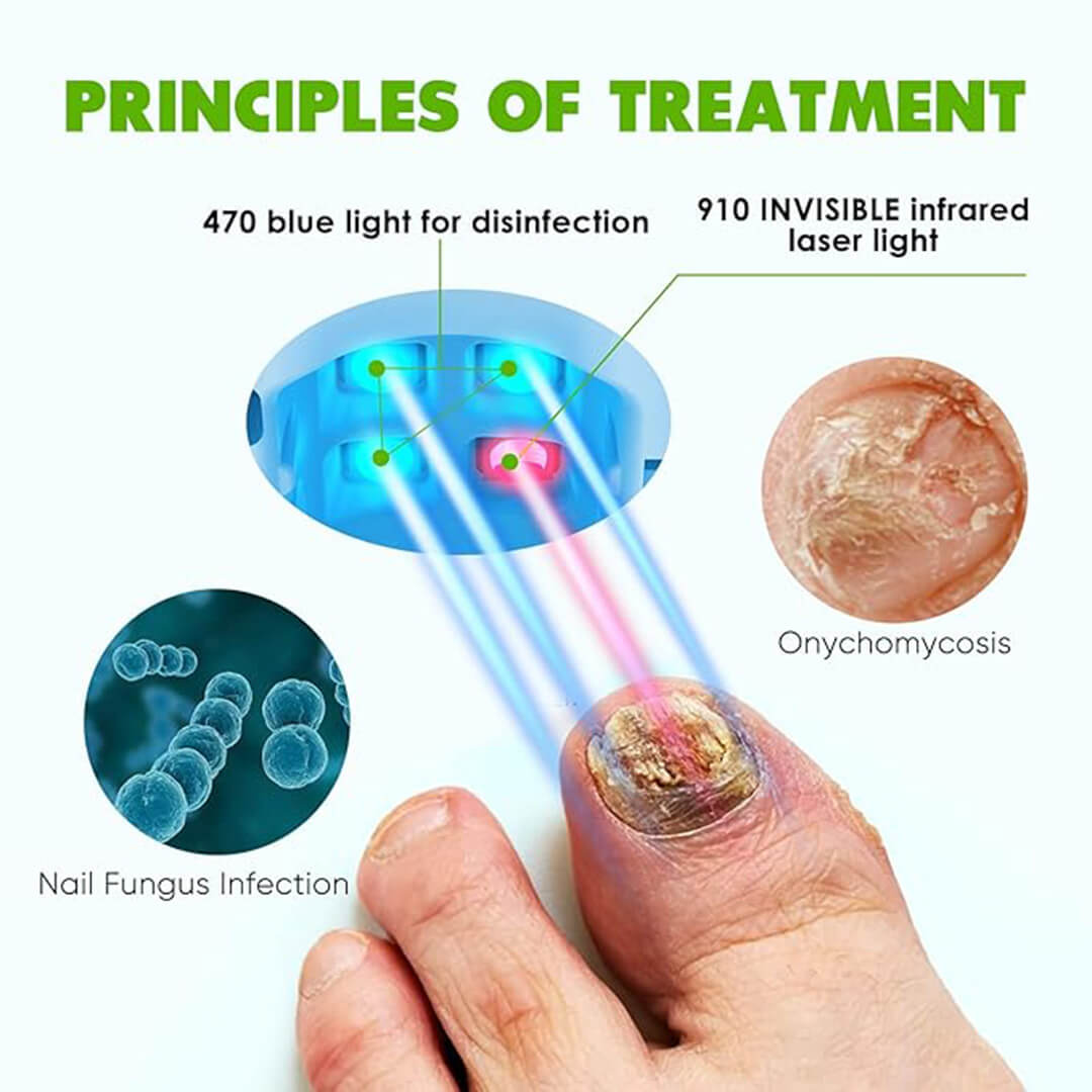 CuraToe™ – Light Therapy for Toenails