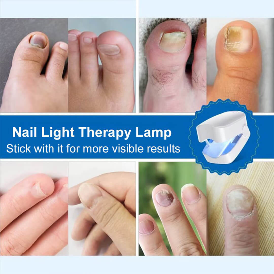 CuraToe™ – Light Therapy for Toenails
