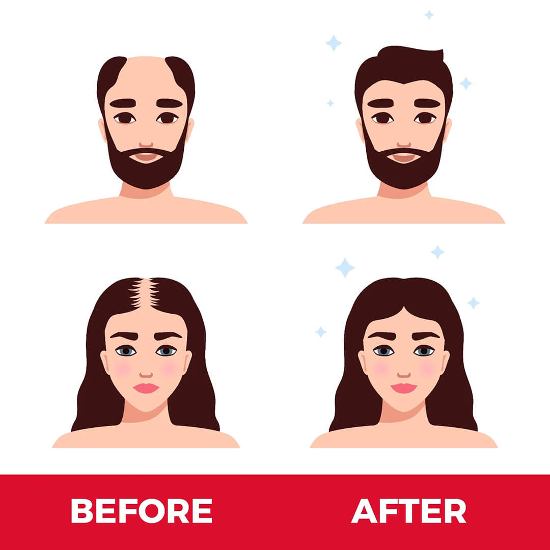 FolliCure™ – Laser Hair Regrowth Cap for Men