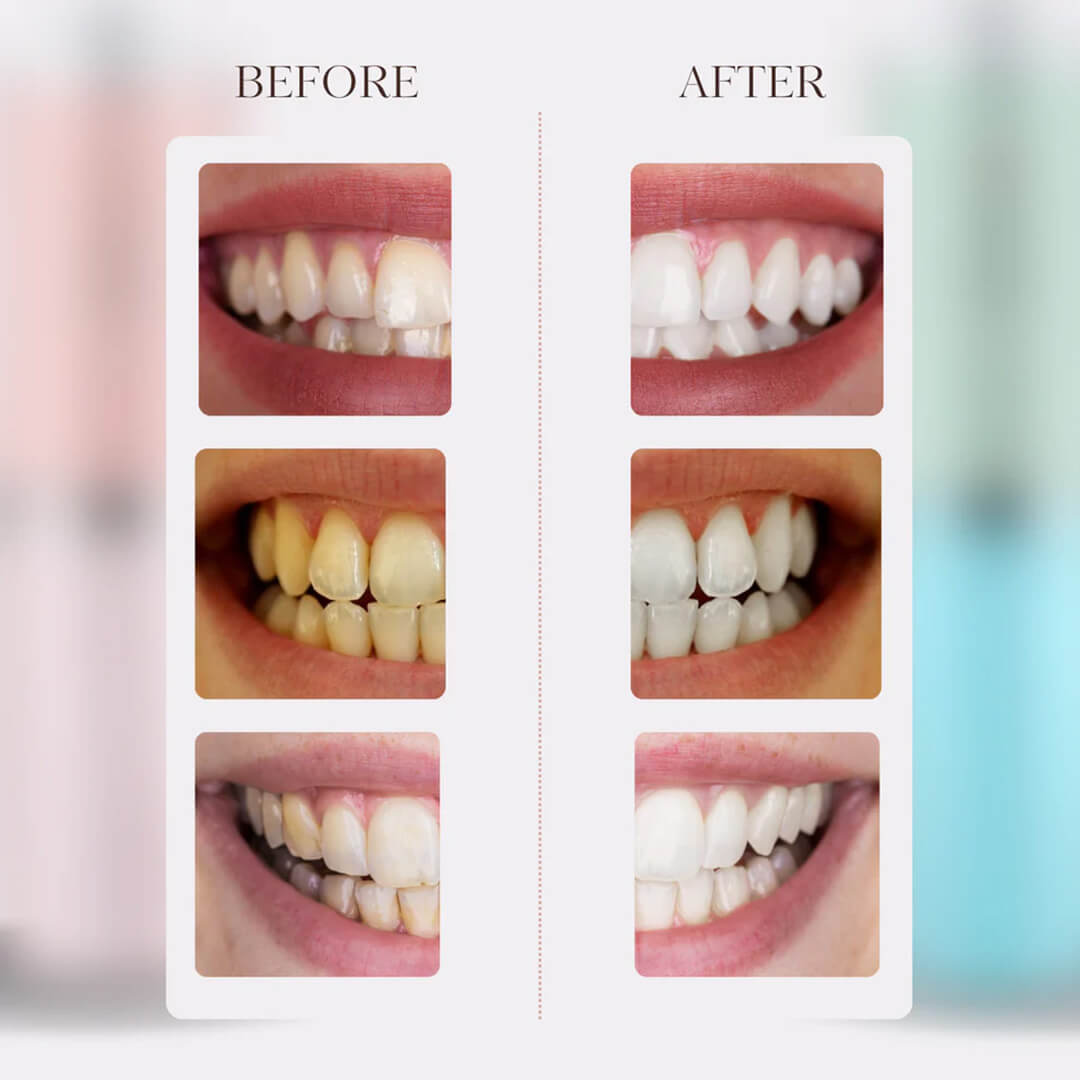 AquaOra™ - Cordless Water Flosser