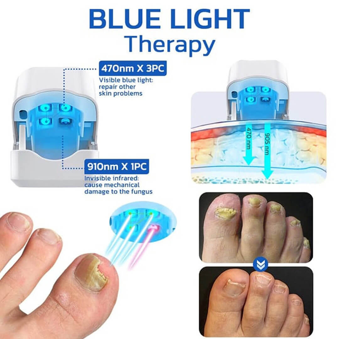 CuraToe™ – Light Therapy for Toenails