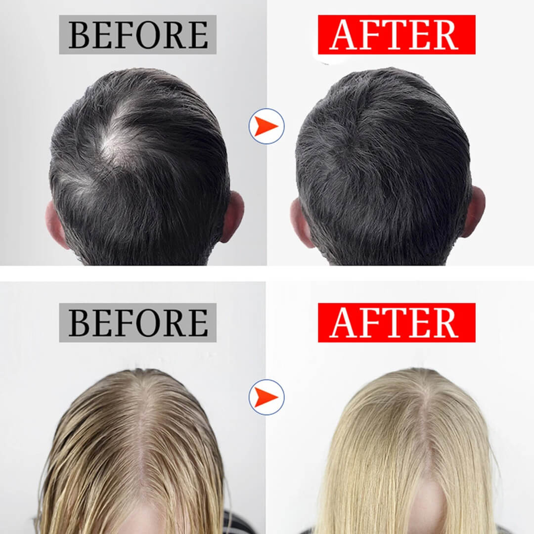 FolliCure™ – Laser Hair Regrowth Cap for Men