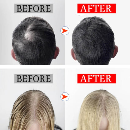 FolliCure™ – Laser Hair Regrowth Cap for Men